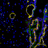 <h5>Beatrice Bedussi</h5><p>Ventricle and choroid plexus of a mouse brain. Tracers (green and red) penetrated in the ventricles but the adjacent veins (yellow- laminin staining) did not show tracers. It points out that paravascular transport of extracellular fluids in the brain does not occur in all vessels, as previously hypothesized. Blue: nuclear stain.</p>