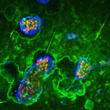 <h5>Teun de Vries</h5><p>Confocal imaging of osteoclasts. In order to prove that multinucleated osteoclasts are functional cells, one has to demonstrate that these cells degrade bone. Here, an experiment is shown where mouse osteoclasts were formed on bovine cortical bone slices. Live osteoclasts were incubated with FITC-labeled lactoferrin (green), nuclei were stained with propidium iodide (red), and cell surface of osteoclasts was stained with anti-CD44 (blue), labeled with Alexa-647. Section A.</p>